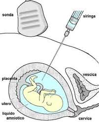 amniocentesi